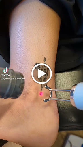 Find tattoo ideas for breast for your next unique tattoo in Reno at Reno Tattoo Removal