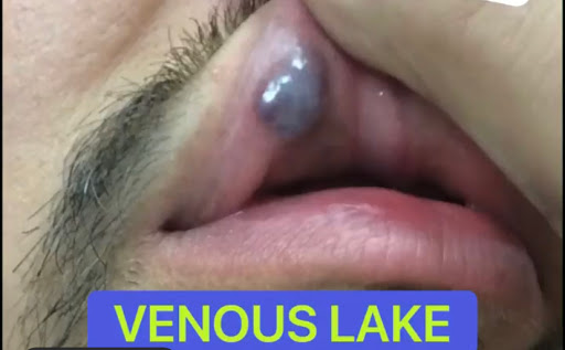 Explore bro and sister tattoo ideas, creative tattoo ideas in Lake Oswego, available at Lake Oswego Vein and Aesthetic LOVA