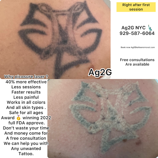 Explore acronym tattoo ideas, creative tattoo ideas in New York, available at Ag2g Laser Tattoo Removal & MedSpa