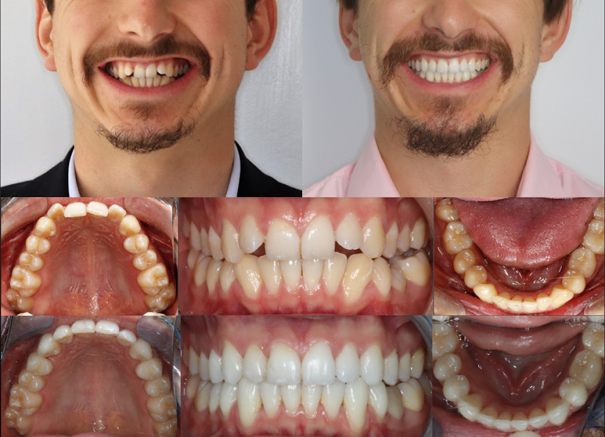 Dr Serge Sobol - Chirurgien dentiste - Orthodontie invisible à Lyon