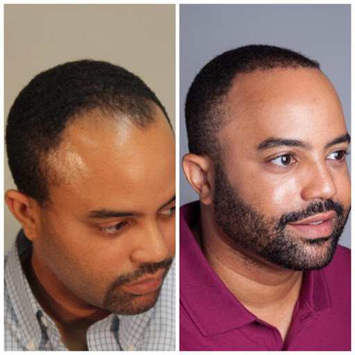 Hair Transplantation Clinic «Bosley Medical - Atlanta», reviews and photos, 3379 Peachtree Rd NE #800, Atlanta, GA 30326, USA