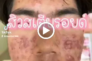 คลีโอ สกิน รักษาสิวลำปาง Cleo Skin Lampang image