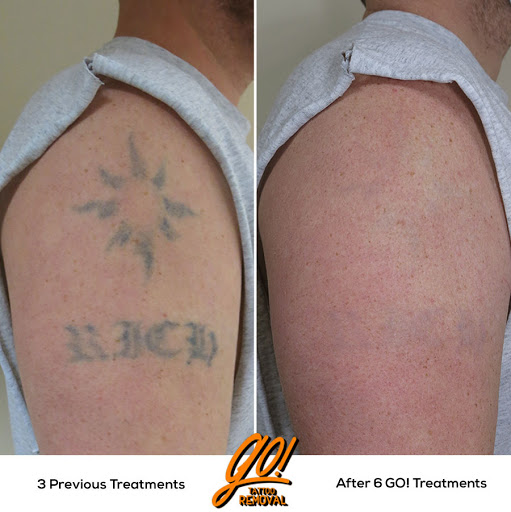 Explore tattoo ideas for domestic violence, creative tattoo ideas in Allentown, available at Removery Tattoo Removal & Fading