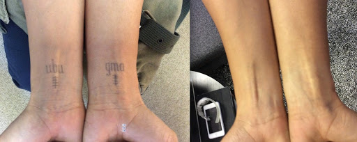 Find mandala tattoo ideas for your next unique tattoo in New York at Removery Tattoo Removal & Fading