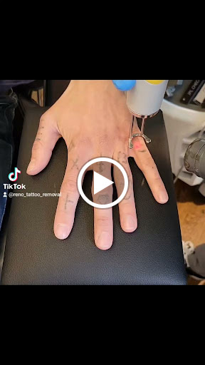 Explore patch work tattoo ideas, creative tattoo ideas in Reno, available at Reno Tattoo Removal