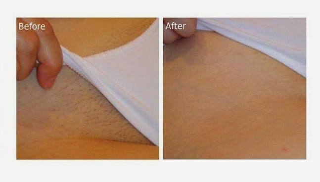 Reveal beauty IPL Hair Removal