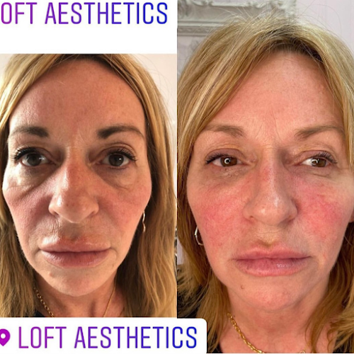Comments and reviews of Loft Aesthetics | Lip Fillers, Dermal Fillers, Worcester