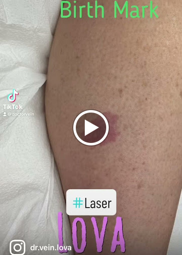 Explore tattoo cover up ideas on hand, creative tattoo ideas in Lake Oswego, available at Lake Oswego Vein and Aesthetic LOVA