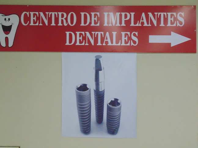Implants Manta