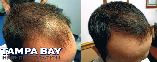 Hair Replacement Service «Tampa Bay Hair Restoration», reviews and photos, 1266 Turner St b, Clearwater, FL 33756, USA