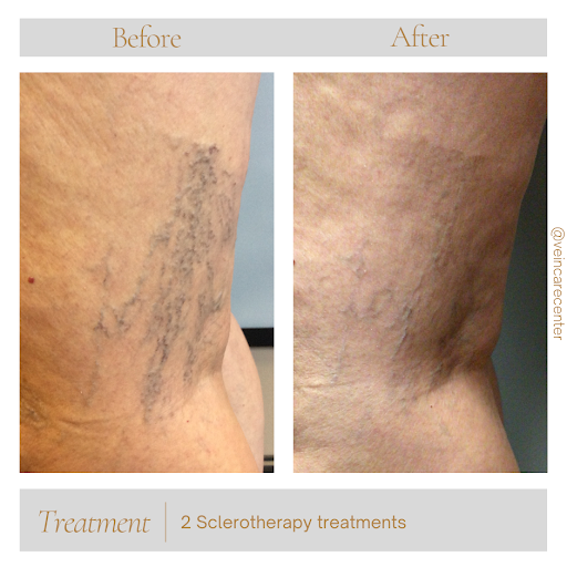 Explore open heart surgery tattoo ideas, creative tattoo ideas in Lima, available at Vein Care Center Laser Specialists