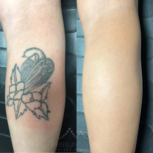 Explore hollow knight tattoo ideas, creative tattoo ideas in Boise, available at Treasure Valley Tattoo Removal