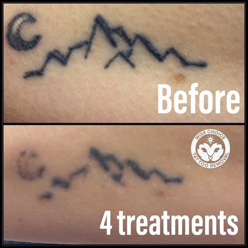 Explore tattoo ideas for cousins, creative tattoo ideas in Denver, available at Wise Choice Tattoo Removal