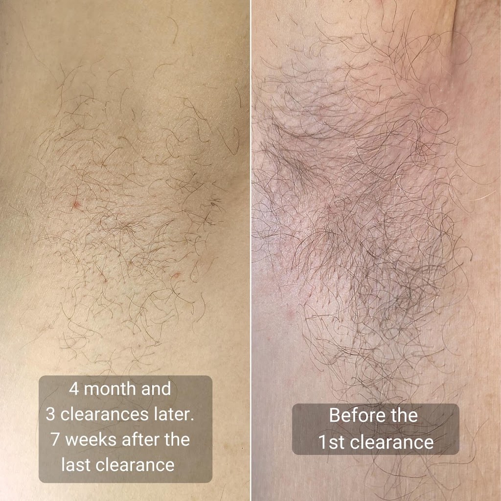 TS Electrolysis 98662