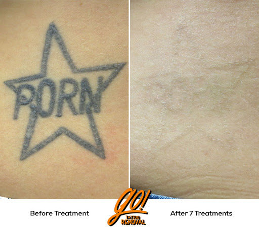 Explore ghetto tattoo ideas, creative tattoo ideas in Allentown, available at Removery Tattoo Removal & Fading