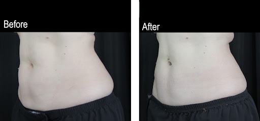 Explore pool tattoo ideas, creative tattoo ideas in Clifton Park, available at Capital Skin Medical Spa