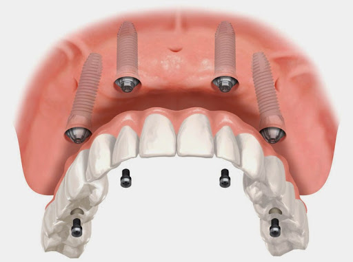 Best Dental Implant Dentar, Stomatologie Copii Sector 1. Proteze Dentare Bucuresti