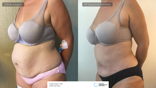 Dr Ozge Ergun Aesthetic Surgery-Breast Lift-Face Lift-Rhinoplasty-Vaser Liposuction-BBL
