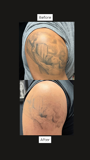 Explore tattoo ideas cancer survivor, creative tattoo ideas in San Antonio, available at San Antonio Tattoo Removal Co.