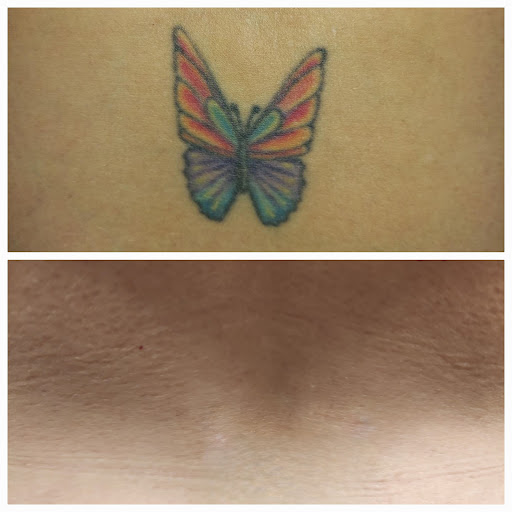 Find lock and key tattoo ideas for your next unique tattoo in Cumming at Atlanta Tattoo Removal