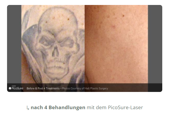 Kommentare und Rezensionen über Tattooentfernung Kreuzlingen