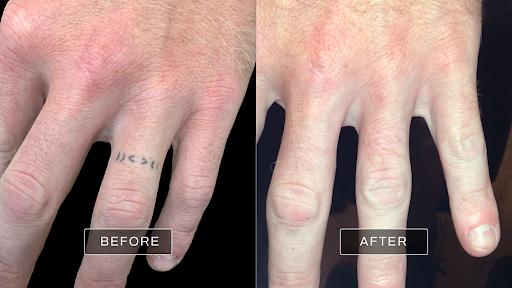 Explore hand wrist tattoo ideas, creative tattoo ideas in Merrick, available at Removery Tattoo Removal & Fading