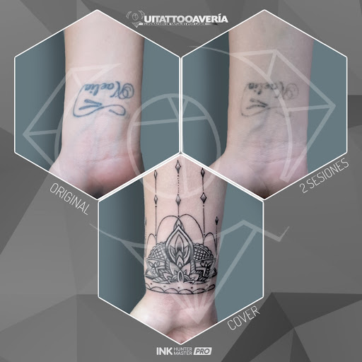 Eliminación de Tatuajes Cuenca - QUITATTOOAVERIA