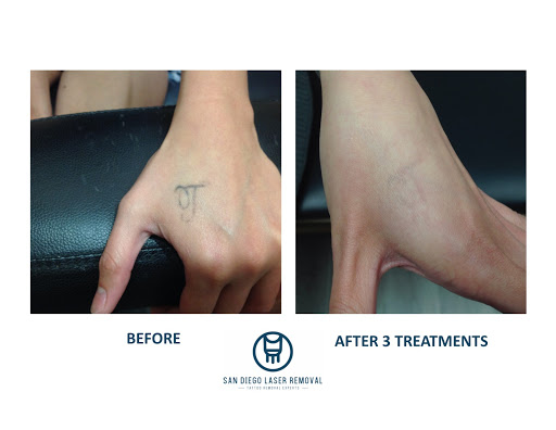 Find beach wave tattoo ideas for your next unique tattoo in San Diego at Removery Tattoo Removal & Fading