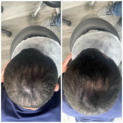 Explore 1776 tattoo ideas, creative tattoo ideas in Roseville, available at NuHair Ink. Scalp MicroPigmentation & Aesthetic Clinic of Sacramento