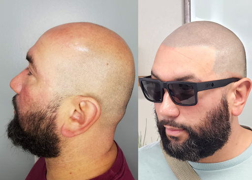 Downey Hair Loss Solutions SMP image