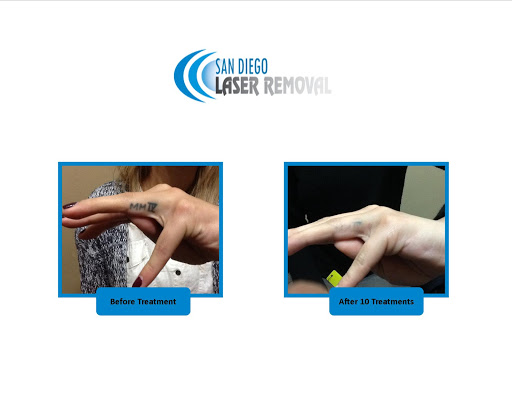 Explore basketball tattoo ideas for guys, creative tattoo ideas in San Diego, available at Removery Tattoo Removal & Fading