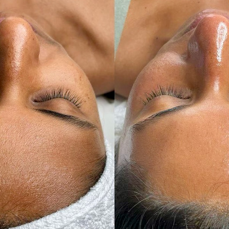 Original-Hydrafacial aus Los Angeles. Akne-Behandlungen.