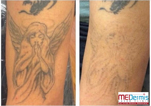 Explore hand finger tattoo ideas, creative tattoo ideas in San Antonio, available at MEDermis Tattoo Removal