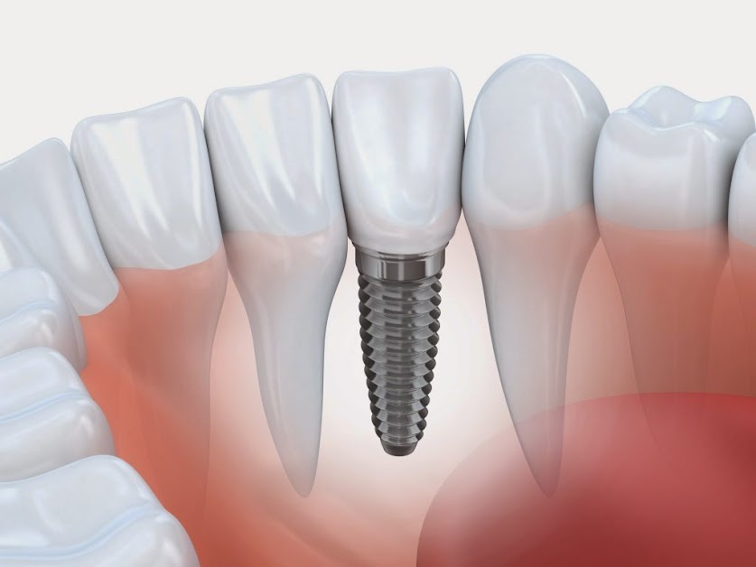 DR LUC FRANCHI-Implants-Parodontie-Prothèse Arles