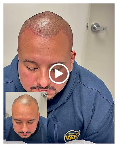 Precise Scalp Micro - Scalp Micropigmentation Service and Training image