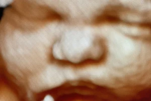 Hide & Seek Prenatal Peek 3D 4D HD Elective Ultrasound image