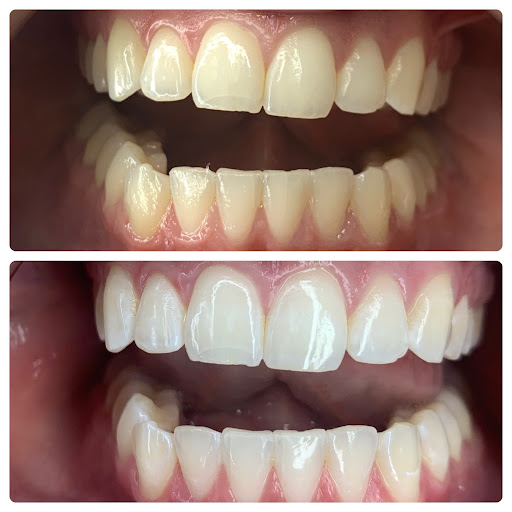 White and Bright Teeth Whitening