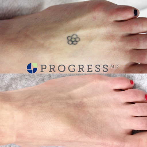 Explore caribbean tattoo ideas, creative tattoo ideas in Amarillo, available at Progress MD Tattoo Removal