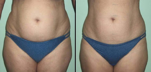 Explore regret tattoo ideas, creative tattoo ideas in Cornelius, available at Purefico MedSpa & Therapy