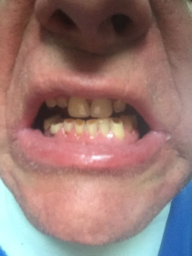 Teeth whitening in Perth