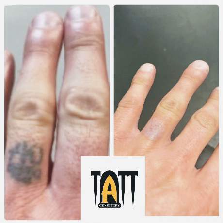 Explore bakugou tattoo ideas, creative tattoo ideas in Fort Myers, available at Laser Tattoo Removal by Tatt Cemetery