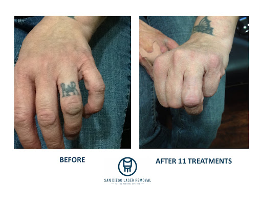 Explore kanye tattoos ideas, creative tattoo ideas in San Diego, available at Removery Tattoo Removal & Fading