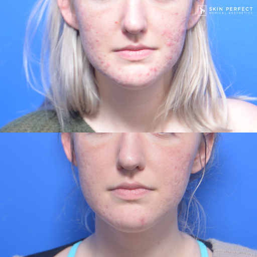 Explore small alice in wonderland tattoo ideas, creative tattoo ideas in Whittier, available at Skin Perfect Medical Aesthetics