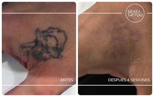 Senza Tattoo L' Hospitalet - Especialistas en eliminación láser de tatuajes