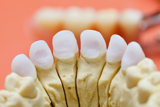 Prótesis dental - Profdent