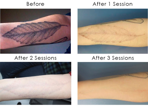 Explore small spider tattoo ideas, creative tattoo ideas in Middle Village, available at Bye Bye Ink Laser Tattoo Removal