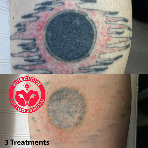 Explore demon slayer tattoo ideas small, creative tattoo ideas in Denver, available at Wise Choice Tattoo Removal