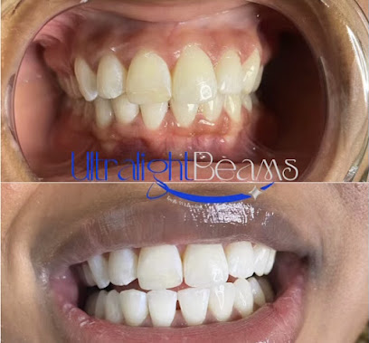 Ultralight Beams Teeth Whitening