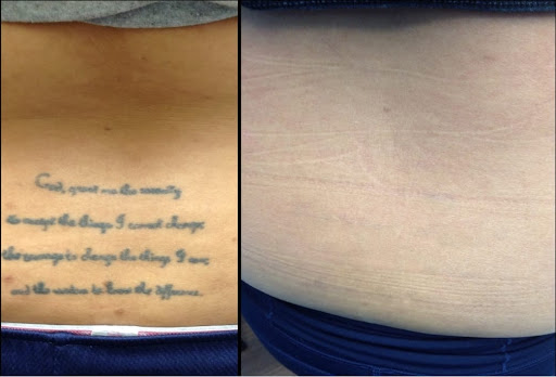 Explore forearm sleeve tattoo ideas for females, creative tattoo ideas in King Of Prussia, available at Inkaway Laser Tattoo Removal