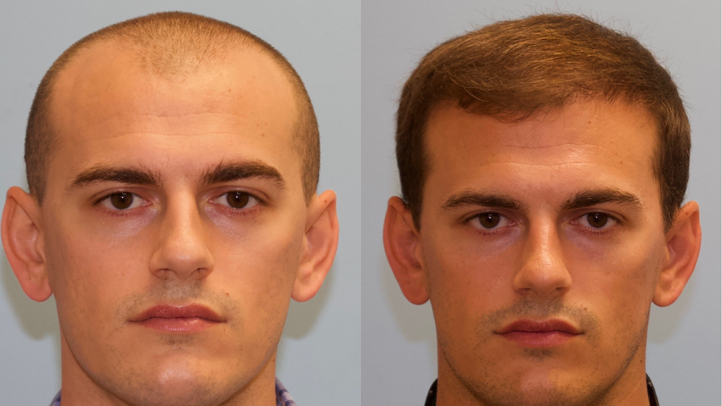 Carolina Hair Surgery: FUE Hair Transplant 29708